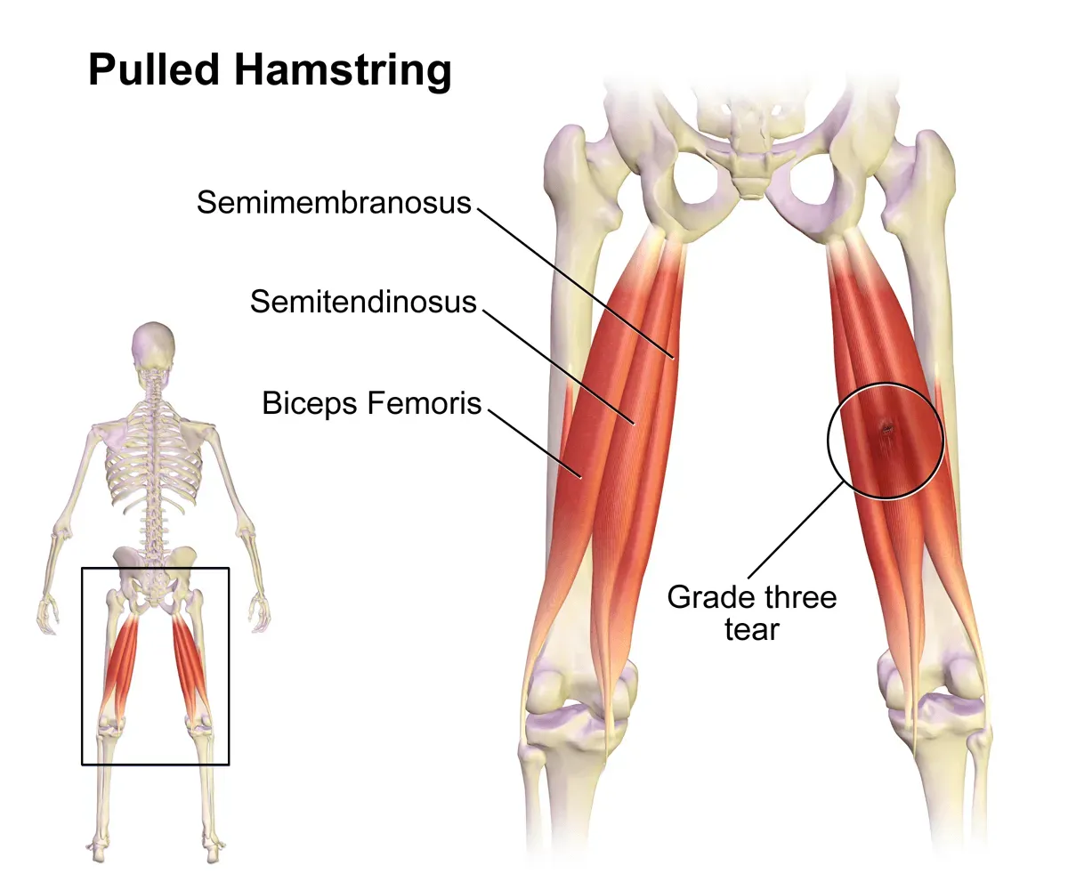 When Can You Start Running After a Hamstring Strain?