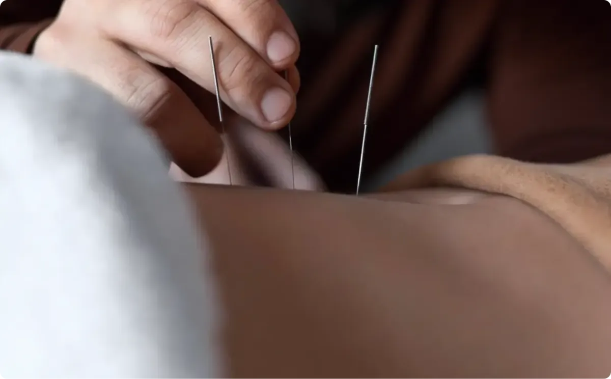 Patient receiving acupuncture treatment at Origins Integrative Health clinic.