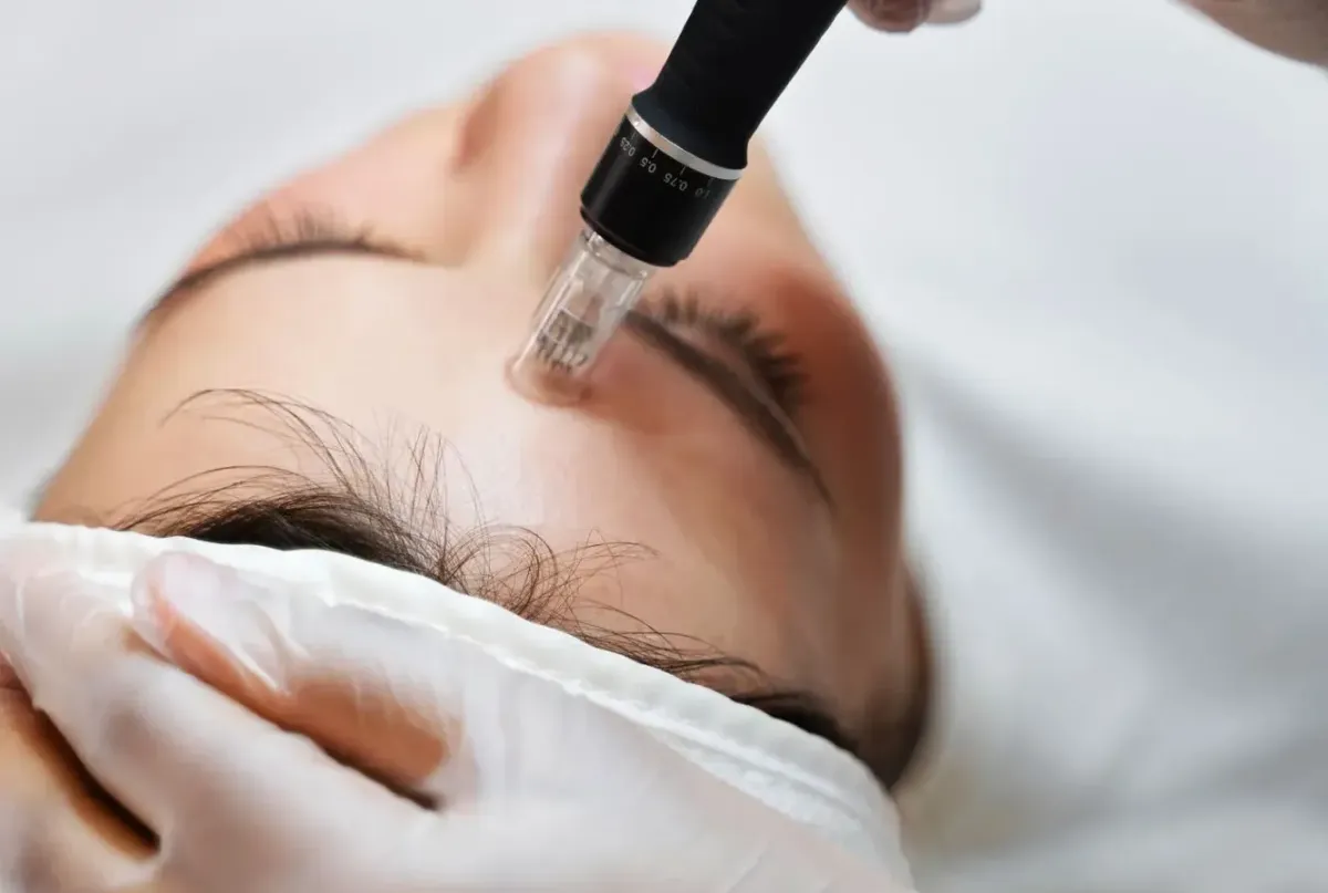 Woman receiving microneedling with PRP therapy.