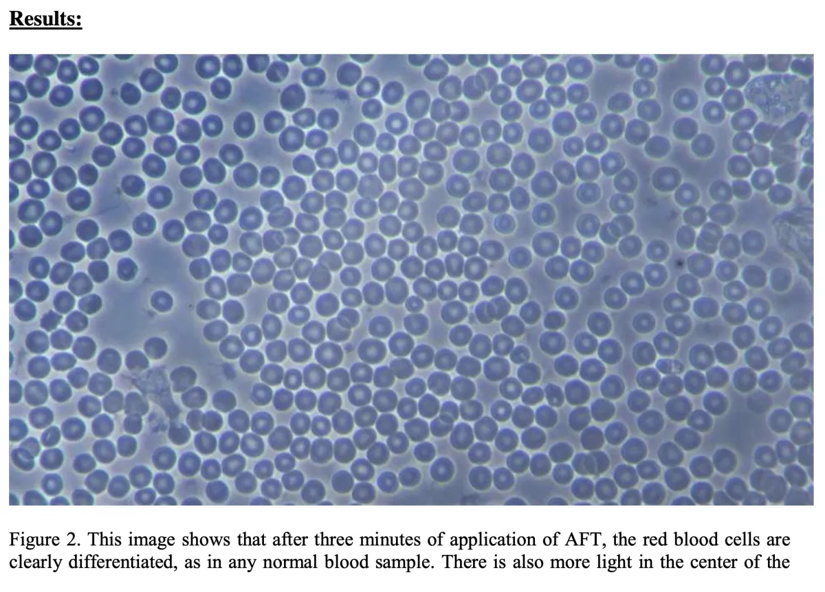 AFT Live Blood analysis ater AFT