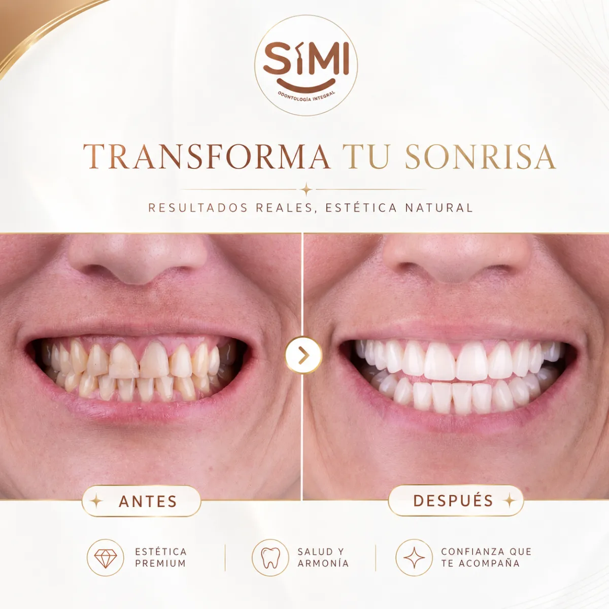 Resultado de paciente - Mamoplastia