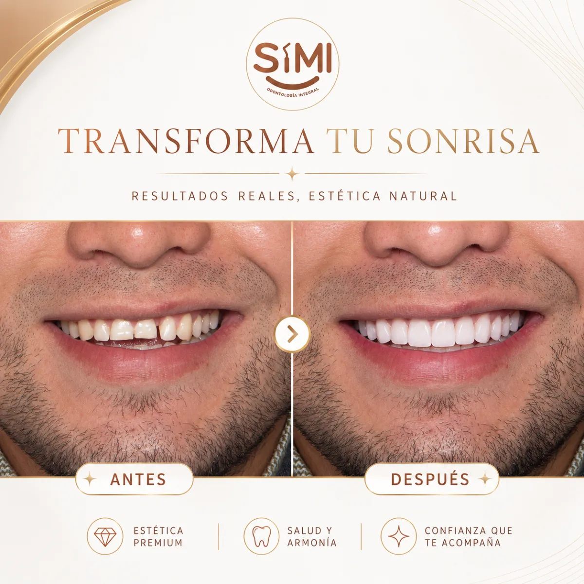 Resultado de paciente - Lifting Facial
