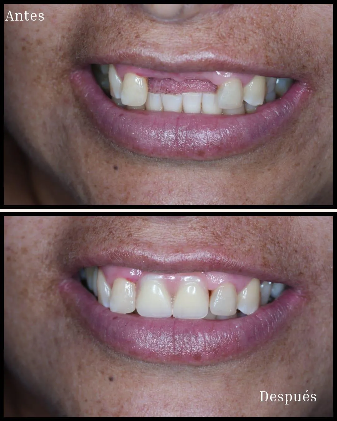Resultado de paciente - Rinoplastia