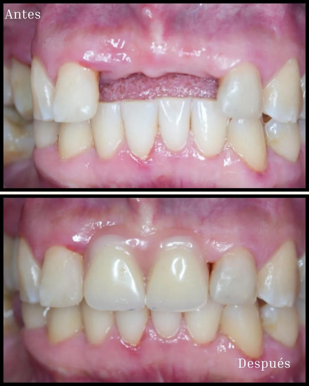 Resultado de paciente - Blefaroplastia