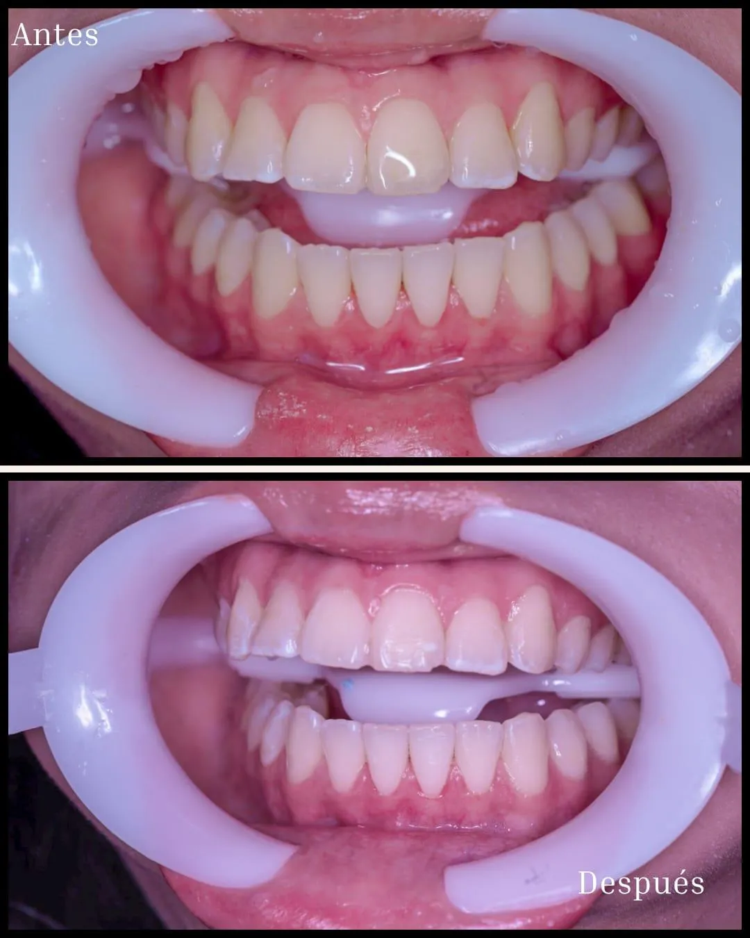 Resultado de paciente - Rinoplastia