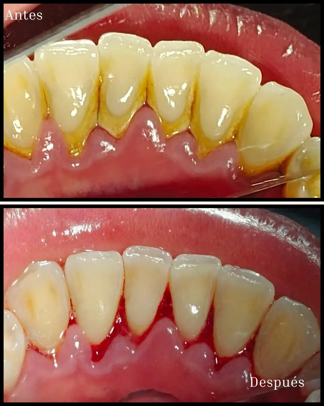Resultado de paciente - Blefaroplastia