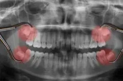 Wisdom Teeth Become Inflamed