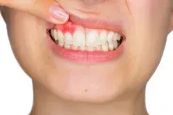 Swelling in Your Gums