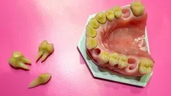 Permanent Tooth Loss