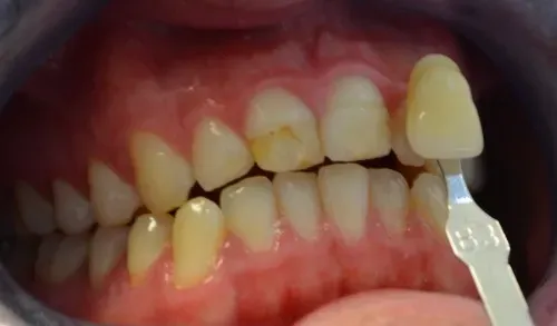 after treatment