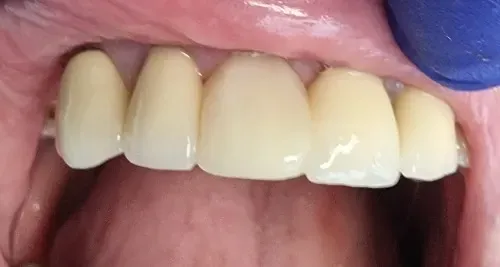 after treatment