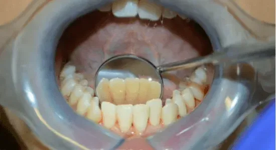 after treatment