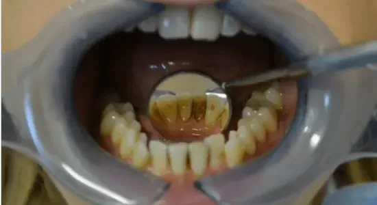 before treatment