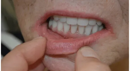 after treatment