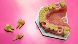 Permanent Tooth Loss