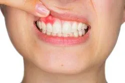 Swelling in Your Gums