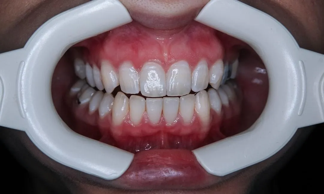 Close-up of teeth during professional dental cleaning and examination