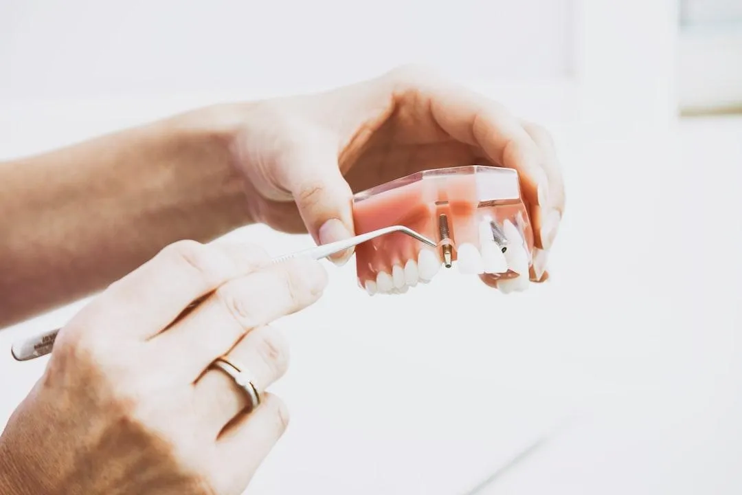Dental implants used to replace missing teeth and restore oral function