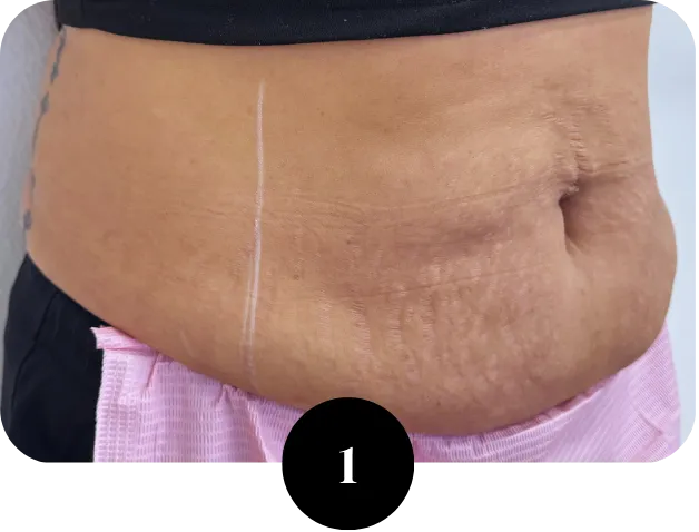 Stretch mark consultation Houston TX assessing candidacy for skin revision treatment