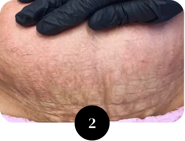 Personalized stretch mark treatment plan Houston TX for scar and skin revision
