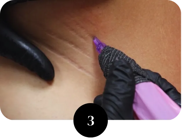 Stretch mark treatment Houston TX starting inkless skin revision procedure