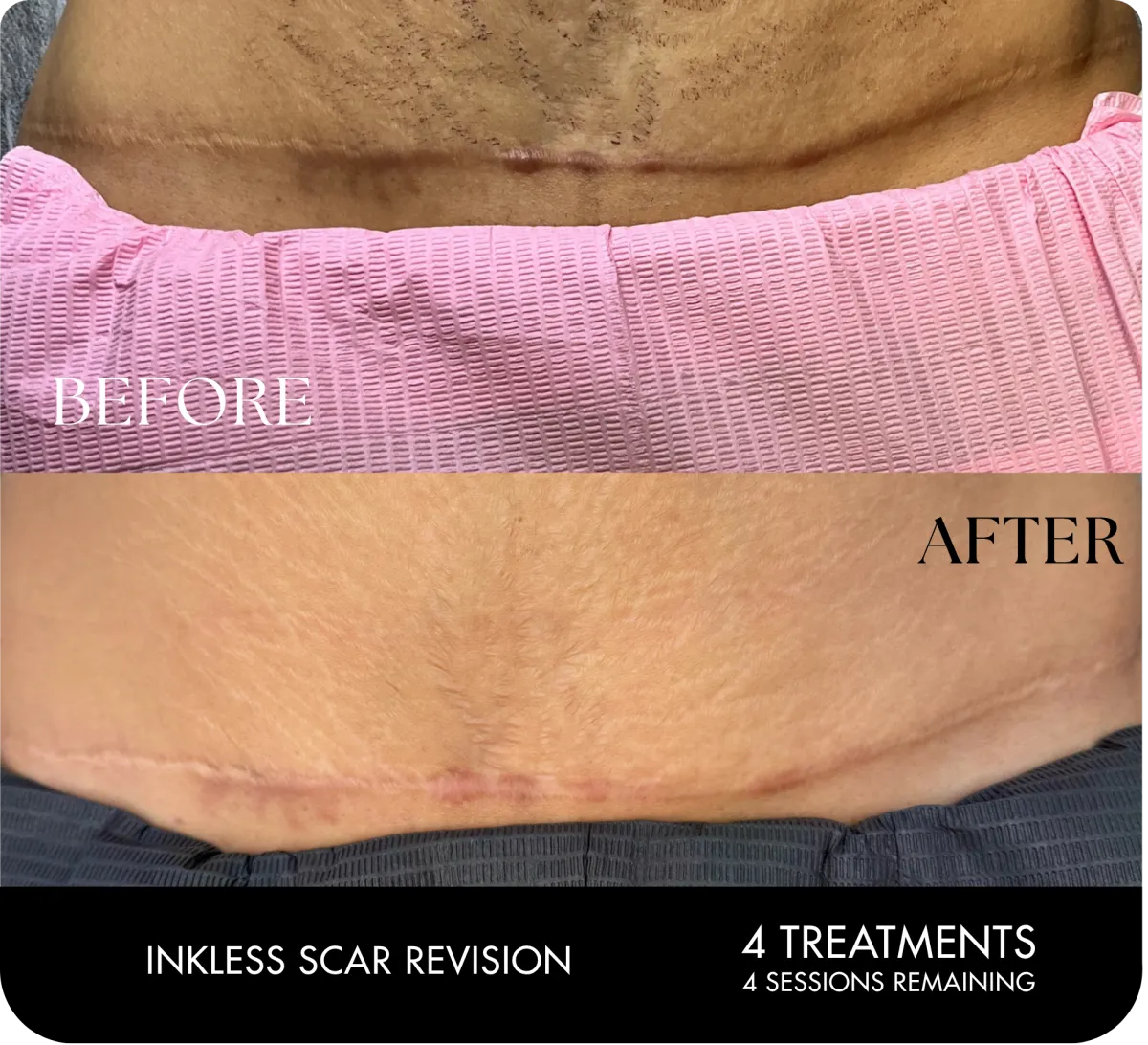 Scar removal Houston TX before and after results using inkless scar revision treatment
