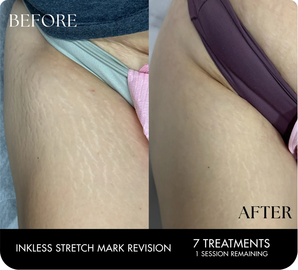 Stretch mark treatment Houston TX before and after results improving skin texture