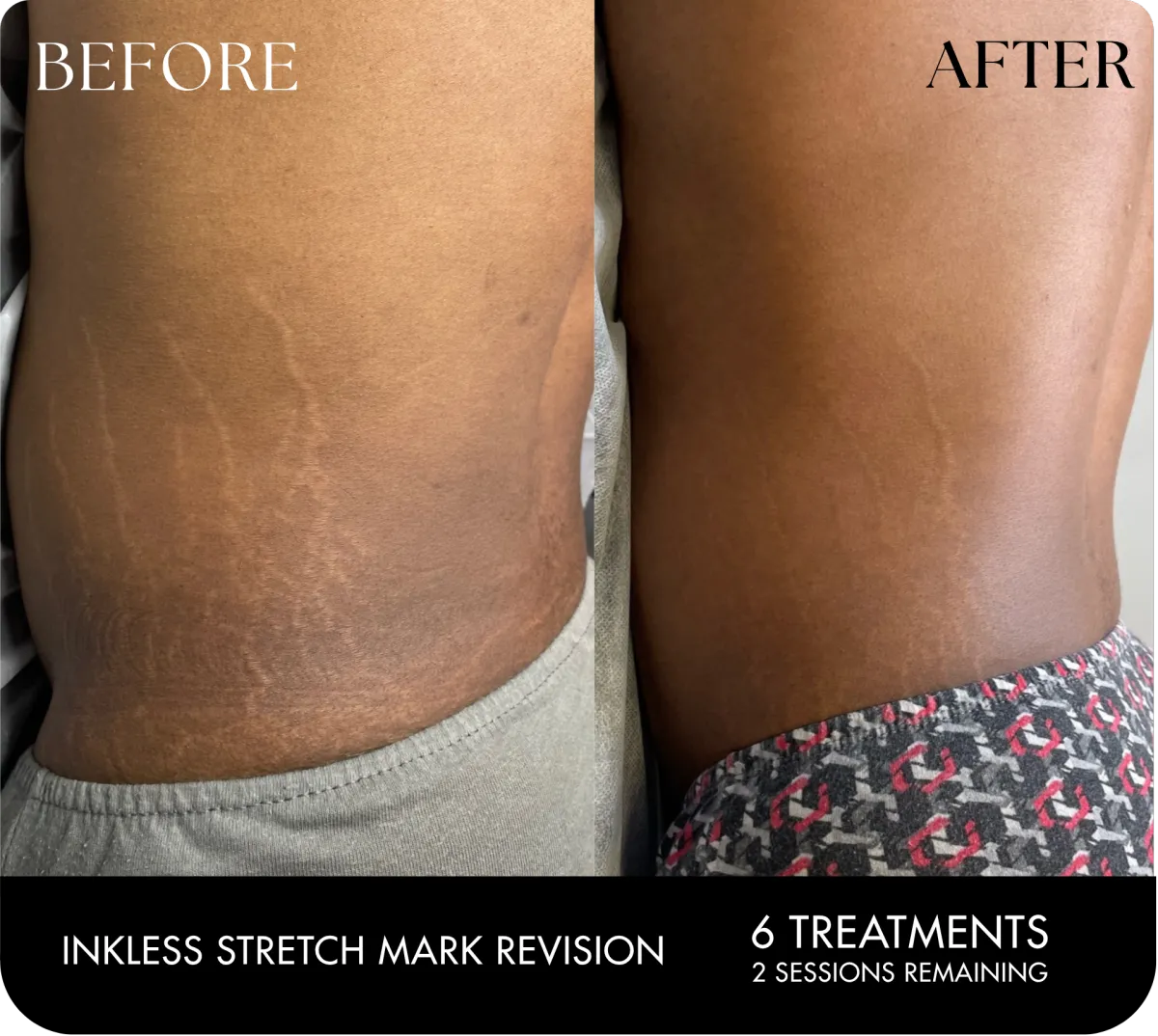 Stretch mark treatment Houston TX for darker skin tones before and after results