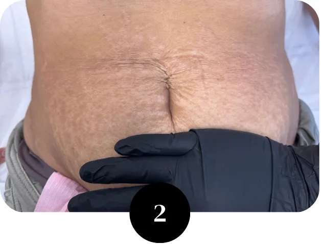 Stretch mark assessment Houston TX creating treatment plan for scar and stretch mark revision