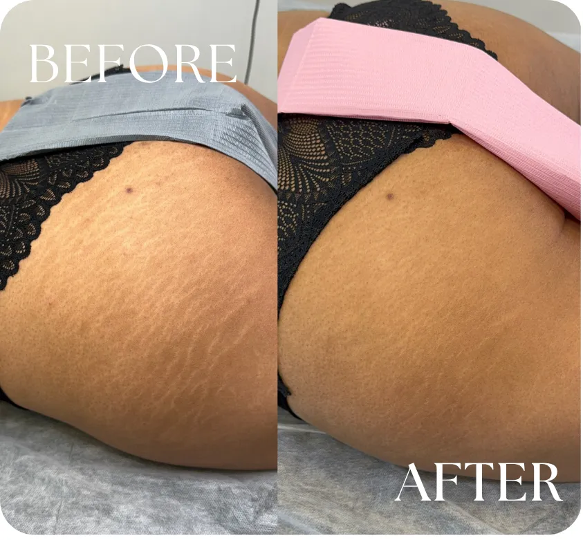Stretch mark removal Houston TX glutes before and after results inkless revision