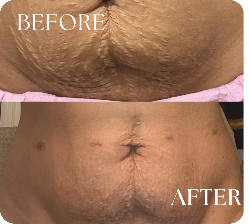 Stretch mark treatment Houston TX lower abdomen before and after inkless revision results