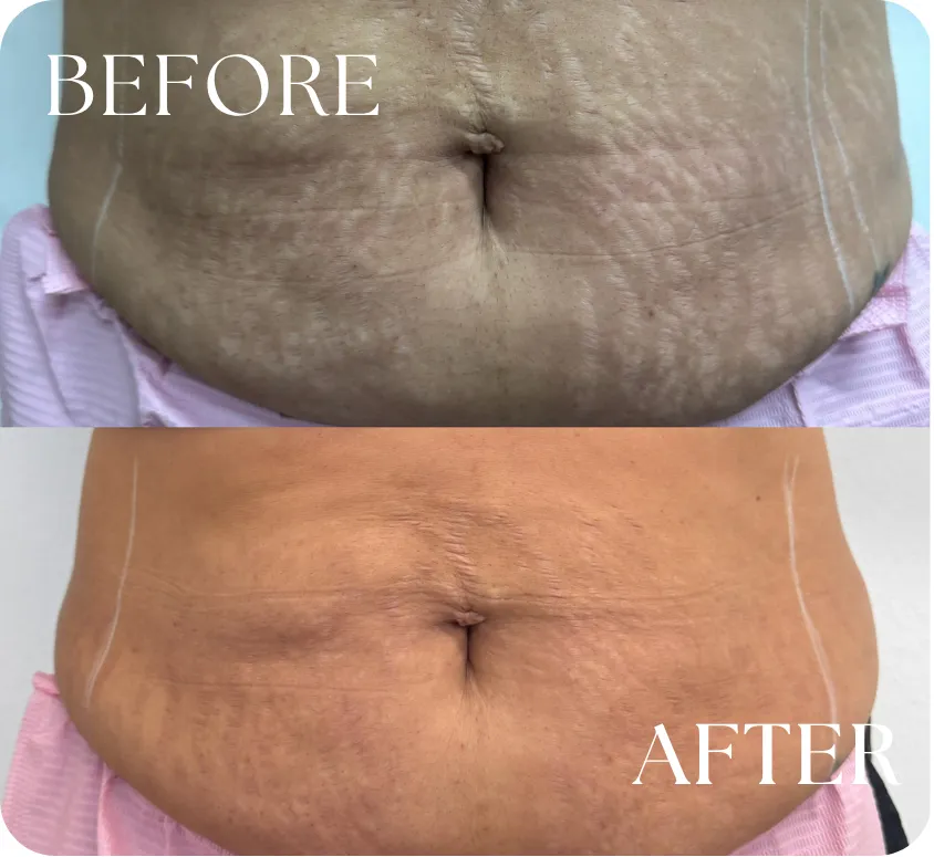 Stretch mark and scar removal Houston TX abdomen before and after results