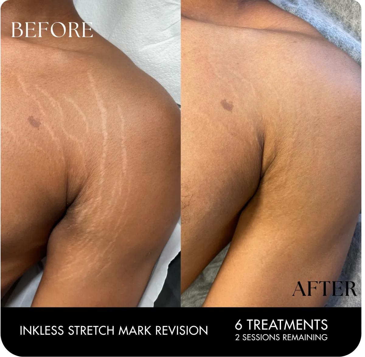 Stretch mark removal Houston TX before and after results using inkless revision treatment