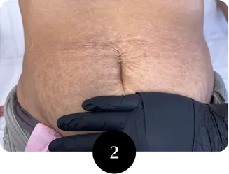 Stretch mark assessment Houston TX creating treatment plan for scar and stretch mark revision