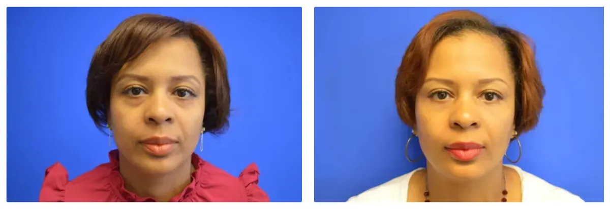 Lower Eyelid Gallery