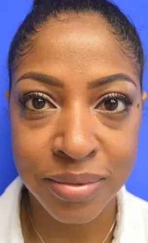 Lower Eyelid Gallery