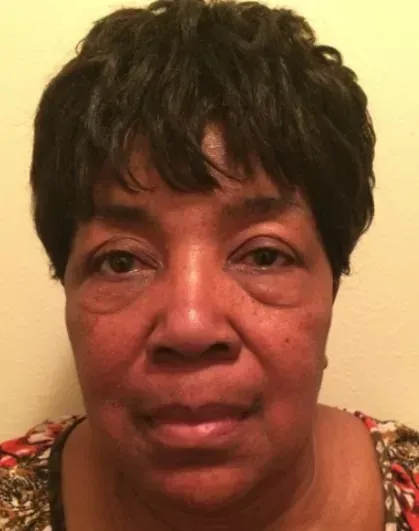 Lower Eyelid Gallery