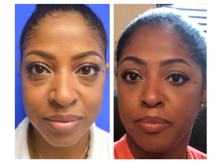 Lower Eyelid Gallery