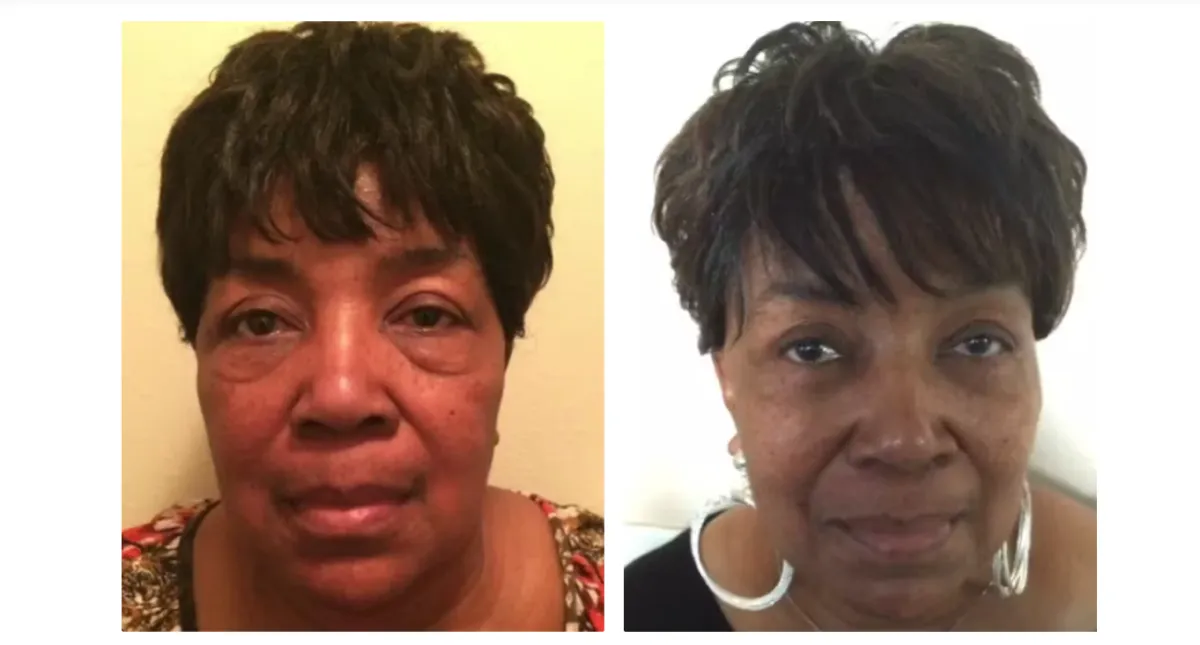 Lower Eyelid Gallery