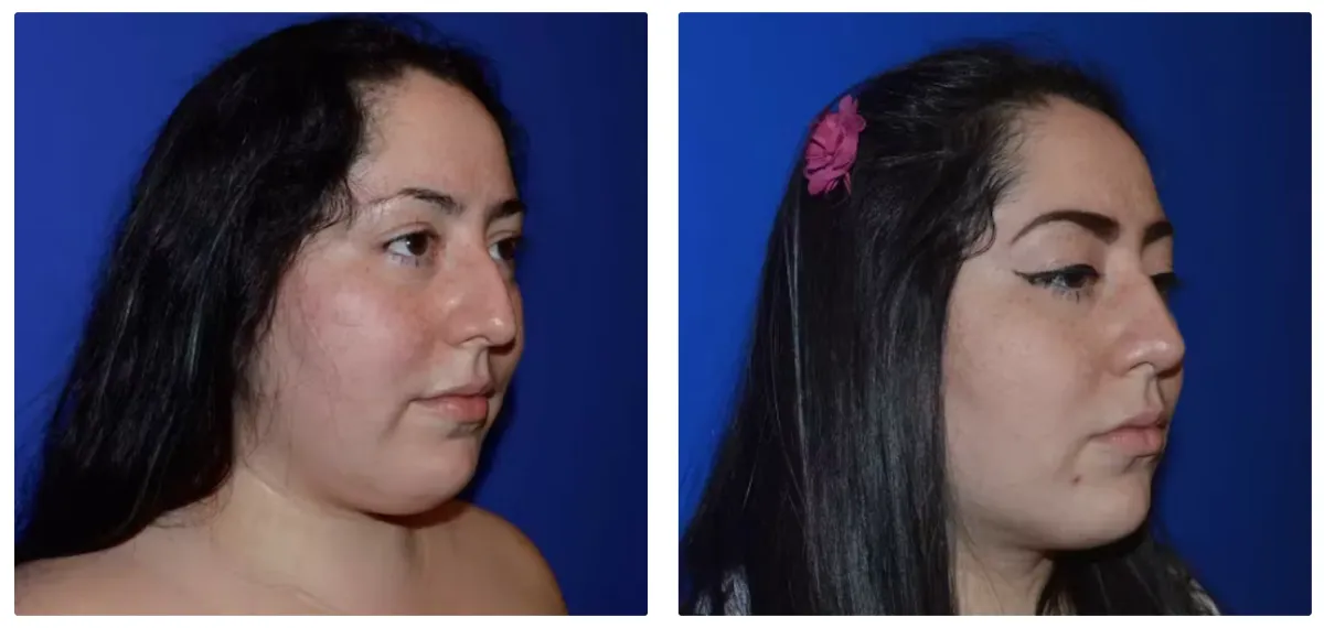 Lower Eyelid Gallery