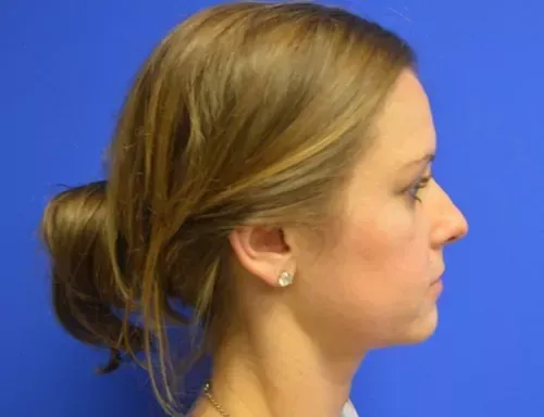Rhinoplasty Gallery