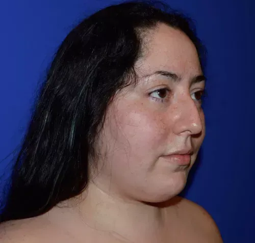 Rhinoplasty Gallery