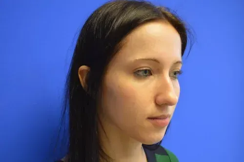Rhinoplasty Gallery