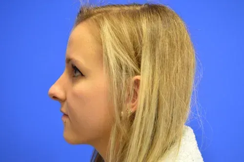 Rhinoplasty Gallery