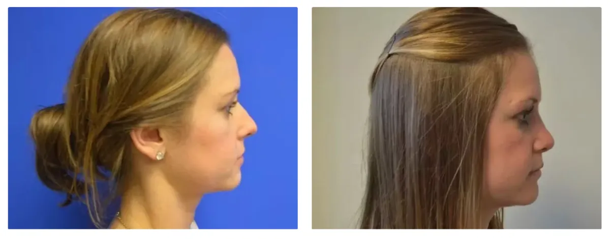 Lower Eyelid Gallery