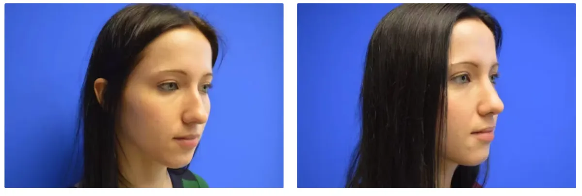 Rhinoplasty Gallery