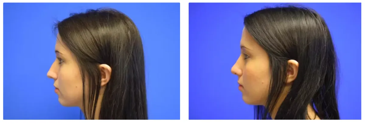 Rhinoplasty Gallery