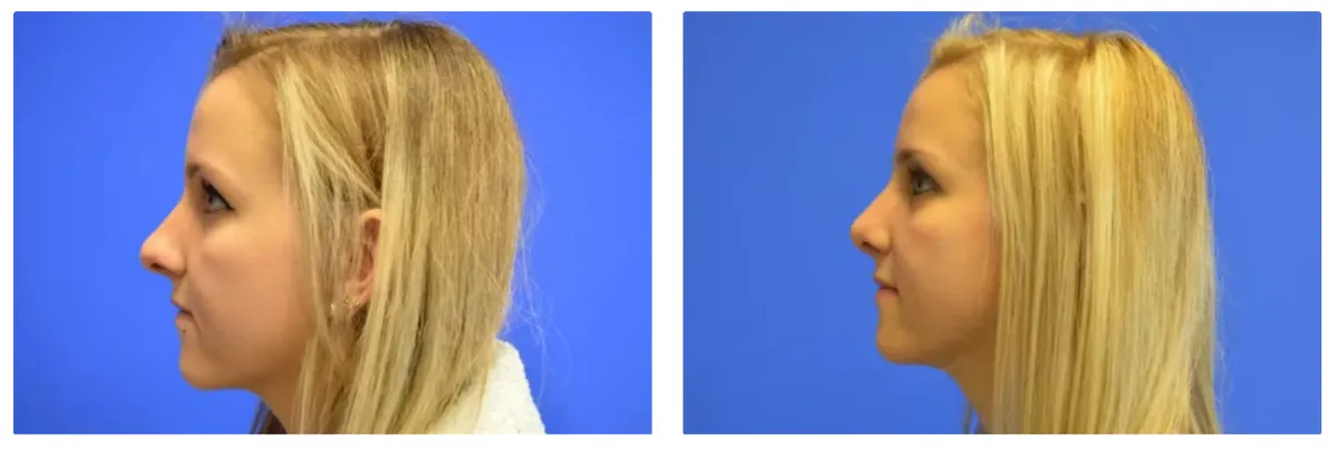 Rhinoplasty Gallery