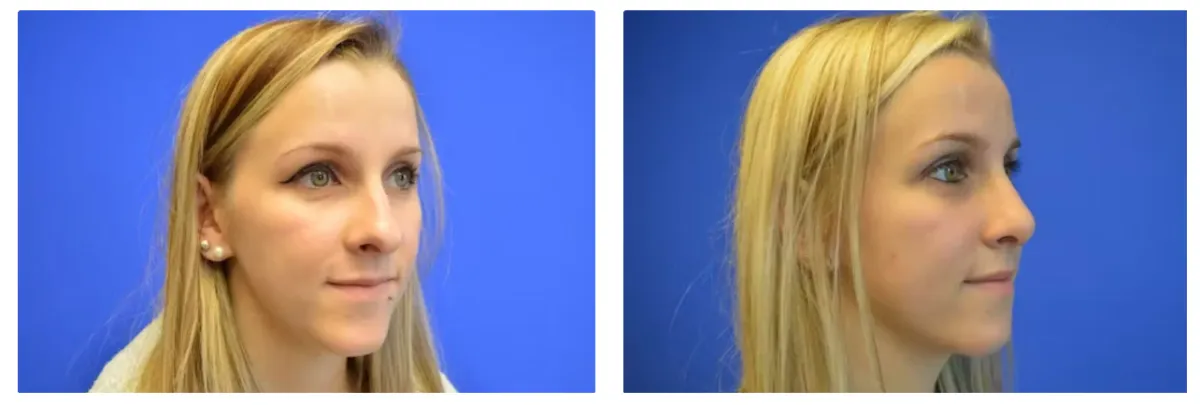 Rhinoplasty Gallery