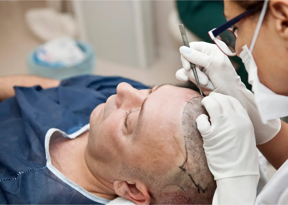 trapianto di capelli tecnica fue e dhi